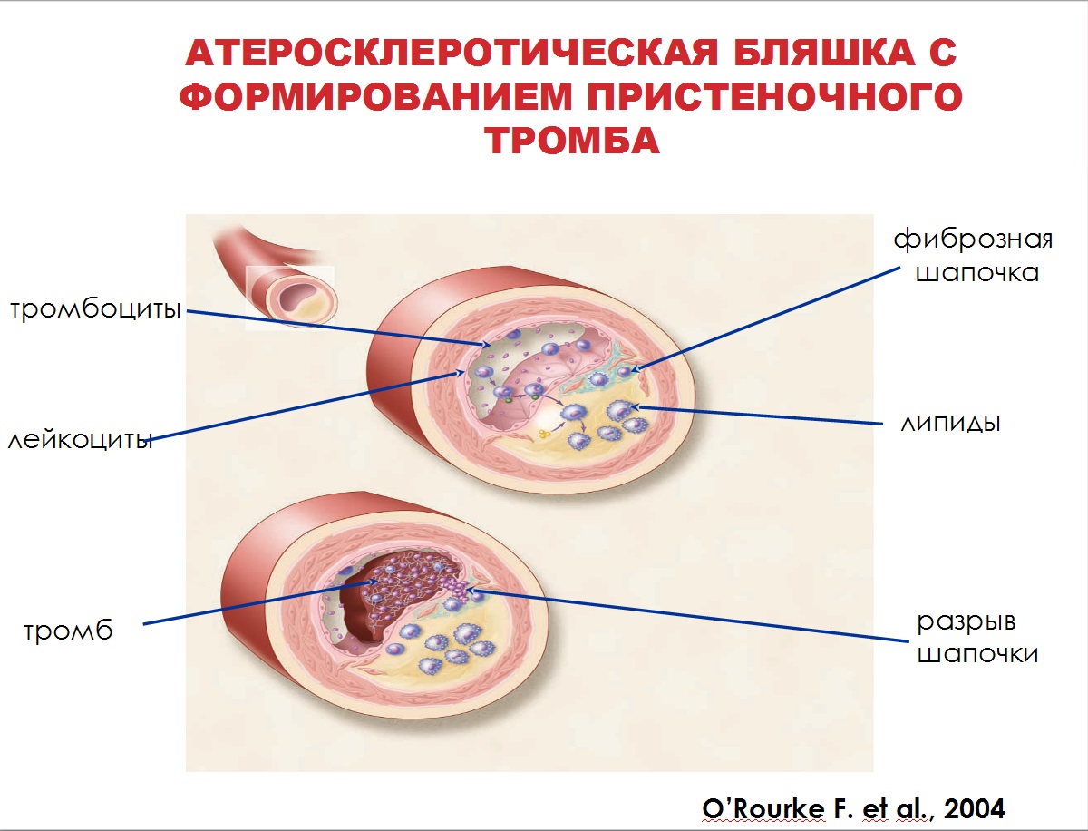 Тромб и бляшка разница. Атеросклеротическая бляшка. Атероклефическвя бляшка. Атеросклеротические бляшки формируются в. Кровоизлияние в атеросклеротическую бляшку.